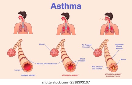 Anatomia da asma. Diagrama médico mostrando as fases do ataque de asma com tubo brônquico saudável e não saudável. Problemas respiratórios e contração do músculo respiratório. Ilustração de vetor plano de desenhos animados