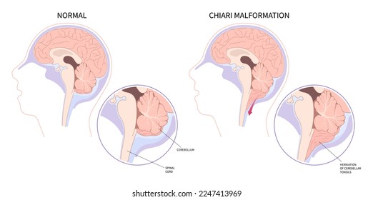 Anatomy of brain cancer tumor bleeding with Chiari malformation