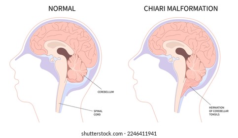 Anatomy of brain with Chiari malformation