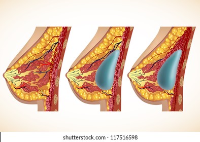Anatomie von Brust und Implantaten. Vektorgrafik