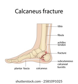 Anatomy of a calcaneal fracture with a diagram of the structure of a broken calcaneus