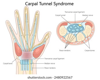 anatomy of carpal tunnel syndrome, highlighting the median nerve, flexor tendons, and carpal bones diagram hand drawn schematic vector illustration. Medical science educational illustration