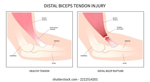 Anatomy Of Distal Biceps Tendon Muscle Tear And Inflammation