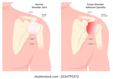 Inflamação e inchaço da articulação do ombro em comparação com a anatomia normal