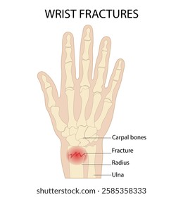 Anatomy of the hand radial dislocation aseptic necrosis displacement fracture painful fall