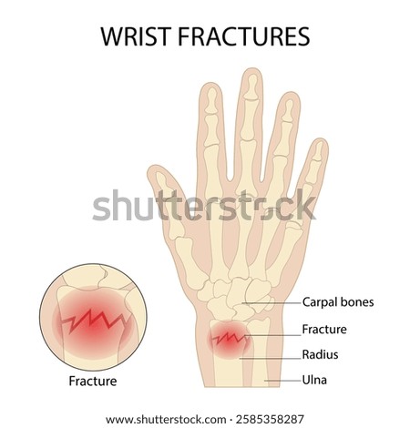 Anatomy of the hand radial dislocation aseptic necrosis displacement fracture painful fall