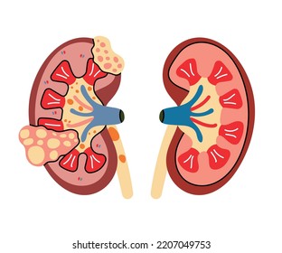 Anatomía del riñón sano y enfermo, vector de línea plana. Modelo de órganos internos humanos, medicina, biología, urología fisiológica. Salud corporal, estructura, cáncer, inflamación, sistema urinario, piedra, tumor