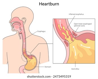 anatomy of heartburn and acid reflux, with labeled parts of the esophagus and stomach diagram hand drawn schematic vector illustration. Medical science educational illustration