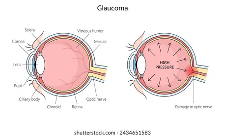 anatomy of a human eye with glaucoma, highlighting increased pressure and optic nerve damage structure diagram hand drawn schematic vector illustration. Medical science educational illustration