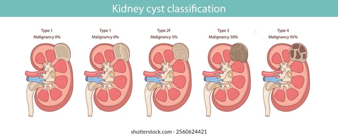 Anatomy of a human kidney cyst. Vector anatomical illustration