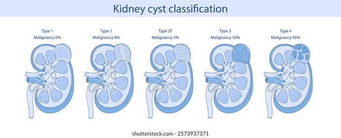 Anatomy of a human kidney cyst. Vector anatomical illustration