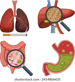 Anatomía de órganos humanos con diversas enfermedades. Ilustración vectorial de los pulmones del fumador, la hepatitis hepática, el virus intestinal y la indigestión. Concepto de medicina