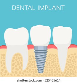 Anatomy of human teeth and Dental implant. Stomatology prosthesis, implantation concept. Vector illustration for web design, poster or advertising brochure