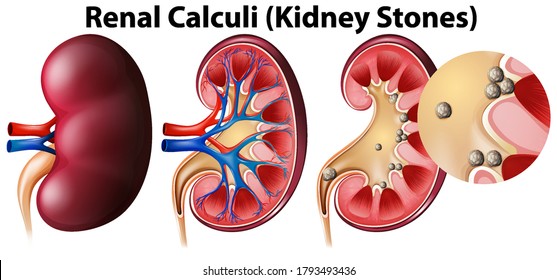 Anatomy of kidney and kidney stones illustration