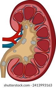 Anatomía de piedras de riñón. Concepto médico de la enfermedad del sistema urinario. Ilustración vectorial de órganos internos humanos