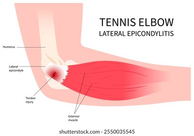 Lesão do ligamento do cotovelo e inflamação muscular que causa dor em