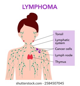 Anatomy of lymph node with cancer cells in woman silhouette. Lymphoma, cancer concept. Swollen human lymphatic system.