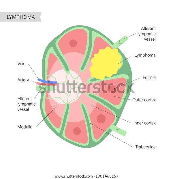 Vektor Stok Anatomy Lymph Node Cancer Illustration Lymphoma Tanpa Royalti 1901463157