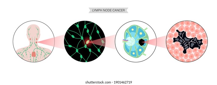 Anatomy Of A Lymph Node With Tumor Cells. Lymphoma And Cancer Concept. Neoplasm, Inflammation In Human Body. Lymphatic System Anatomical Medical Poster For Clinic Or Education Flat Vector Illustration