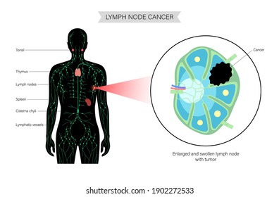 Anatomía de ganglios linfáticos con células tumorales en la silueta humana. Linfoma, concepto de cáncer. Inflamación del sistema linfático humano. Neoplasia e inflamación en conductos axilares macho ilustración anatómica vectorial plana