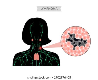 Anatomía de nódulos linfáticos con células tumorales en la silueta de mujer. Linfoma, concepto de cáncer. Inflamación del sistema linfático humano. Neoplasia e Inflamación en el conducto del cuello. Ilustración anatómica de pancarta plana vectorial