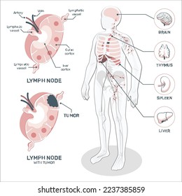 Anatomía de un nódulo linfático con células tumorales. El concepto de linfoma y cáncer. Neoplasia, inflamación en el cuerpo humano. Afiche médico anatómico del sistema linfático para ilustración vectorial plana de clínica o educación