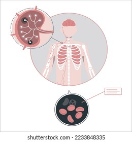 Anatomy of lymph node with tumor in man or boy silhouette. Lymphoma, cancer and swollen human lymphatic system. Neoplasm, inflammation in neck ducts anatomical banner isolated flat vector illustration