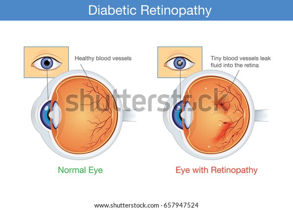 Anatomy of normal\
eye and Diabetic retinopathy in people who have diabetes.\
Illustration about health and\
eyesight.