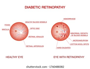 Anatomy of normal eye and Diabetic retinopathy.Diagram of the eye.
