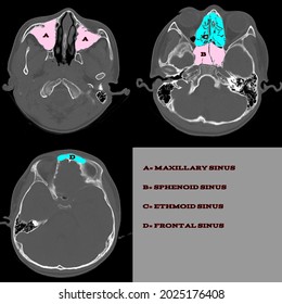 124 Para nasal sinuses Images, Stock Photos & Vectors | Shutterstock