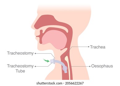 The anatomy of a patient is intubated at the neck into the trachea to help breath. Medical Diagram about Tracheostomy is surgical at the airway system.