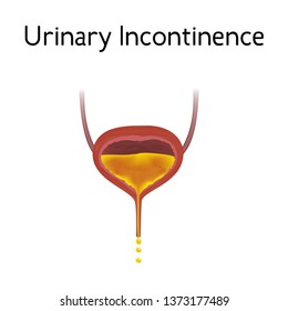 Anatomy Picture Of Urinary Incontinence. Realistic Medical Illustration.