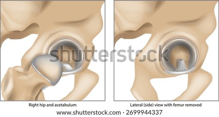 Anatomy of the right hip joint and acetabulum showing the acetabular labrum and ligamentum teres. Femoral head removed on right. arthroscopic ligamentum teres debridement, resection