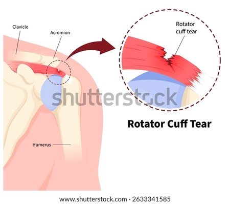 Anatomy of shoulder Rotator cuff tear and injury