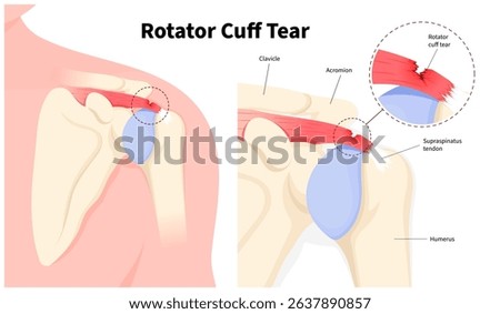 Anatomy of shoulder Rotator cuff tear disease causes pain and stiffness