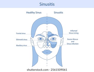 Anatomy of the sinus from the front. Hand drawn anatomical vector illustration.Flat image of sinusitis and sinusitis. Infections, inflammations, nasal diseases.