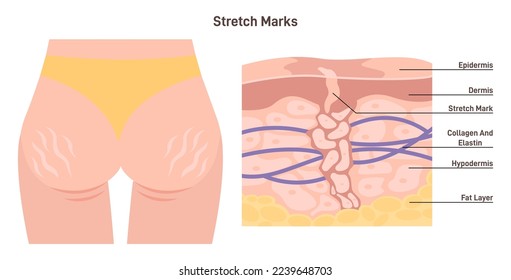 Anatomy of skin with stretch marks. Skin stretches or shrinks quickly. Skin collagen and elastin lack. Flat vector illustration