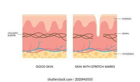 Anatomy of skin with and without stretch marks. Collagen, elastin, striae. Body positivity, beauty, skincare concepts