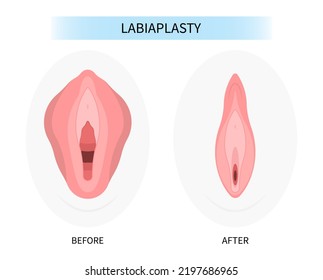Anatomy of the vocal cords in larynx and laryngeal cavity for medical
