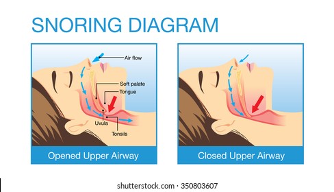 Anatomy of woman while normal sleeping and have snoring. Illustration about health care and medical