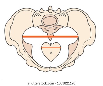 Android Pelvis Shape w Triangular or Heart shape