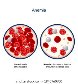 Anemia. comparison and difference between Normal levels of hemoglobin and decrease in the total amount of red blood cells. Close-up of blood vessel with erythrocyte, platelets and white blood cells