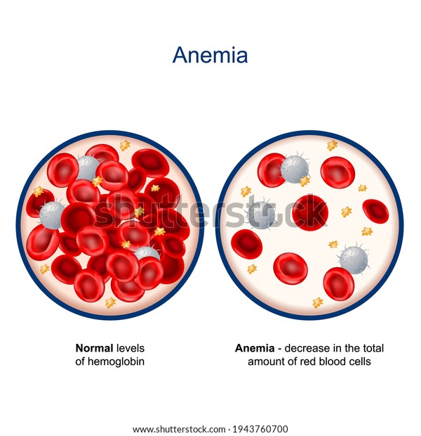 Anemia Comparison Difference Between Normal Levels Stock Vector Royalty Free 1943760700