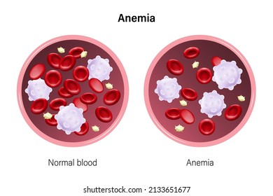 1,935 Red blood cell count Images, Stock Photos & Vectors | Shutterstock