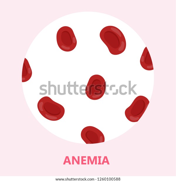 Anemia Disease Problem Hemoglobin Lack Iron Stock Vector (Royalty Free ...