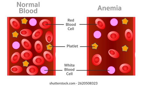 Anemia, low level red blood cells. Section showing normal and anemia blood contents. Vector illustration