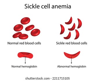 Anemia Normal Red Blood Cell Sickle Stock Vector (Royalty Free ...