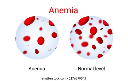 Anemia Problem Circulatory Iron Body Diagram Background. Anaemia Biology Blood Isolated Medical Normal Icon