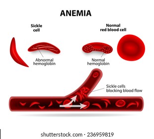 Anemia. Sickle Cell And Normal Red Blood Cell