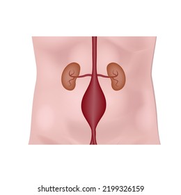 Aneurysm Of The Abdominal Aorta. Diagram With Kidneys On The Background Of The Torso. Medical Poster. Vector Illustration